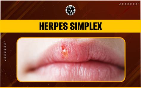 Herpes Simplex: Introduction, Causes, Symptoms, Treatment