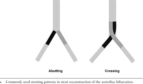 Kissing Iliac Stents