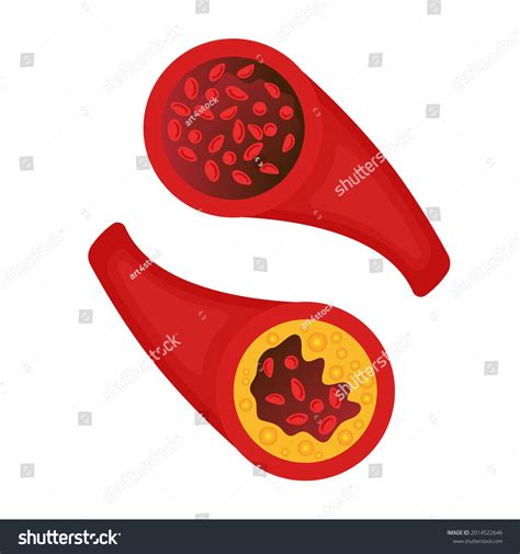 Normal Blood Vessel Versus Artery Cholesterol Stock Vector Royalty