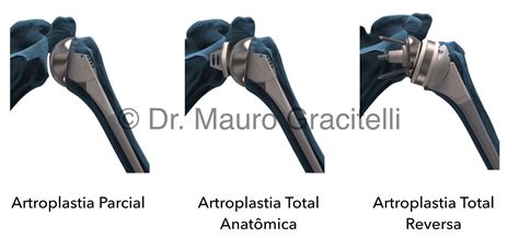 Artroplastia Do Ombro Dr Mauro Gracitelli