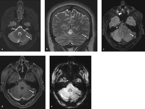 2 Arachnoid Granulations Radiology Key