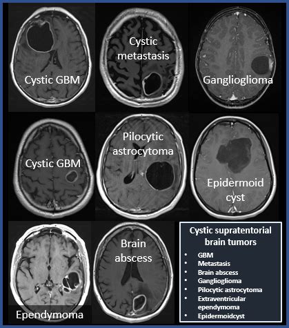 The Neuroradiologist On Twitter Cystic Supratentorial Brain Tumors In