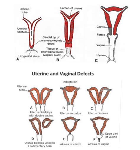 Bicornuate Uterus Statpearls Ncbi Bookshelf