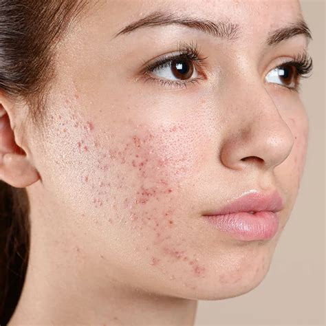 Acne Skininspire