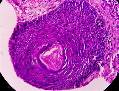 Biópsia De Pele Sob Microscopia Sugestiva De Carcinoma Basocelular O