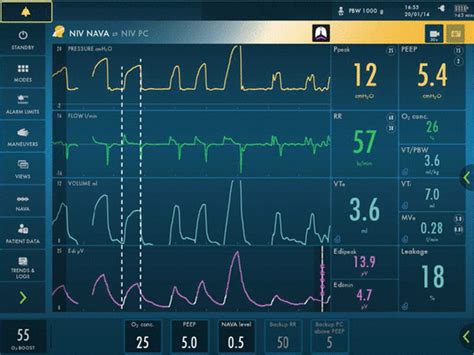 Noninvasive Neurally Adjusted Ventilatory Assist Niv Nava In Children