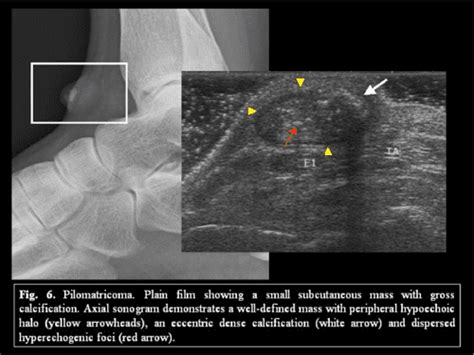 Benign Lesions Of The Subcutaneous Soft Tissue With Calcifications Which Is The Role Of