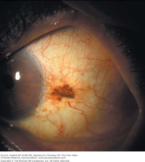 What Causes Brown Spots On Sclera