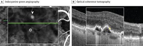 Indocyanine green - Ferst Eye Institute