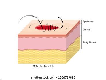 83 Subcuticular Images, Stock Photos & Vectors | Shutterstock