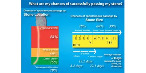 Stages Of Passing Kidney Stones Kidney Stones Clinic