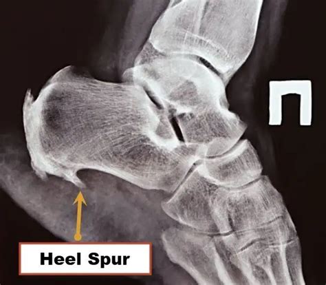 Heel Spur