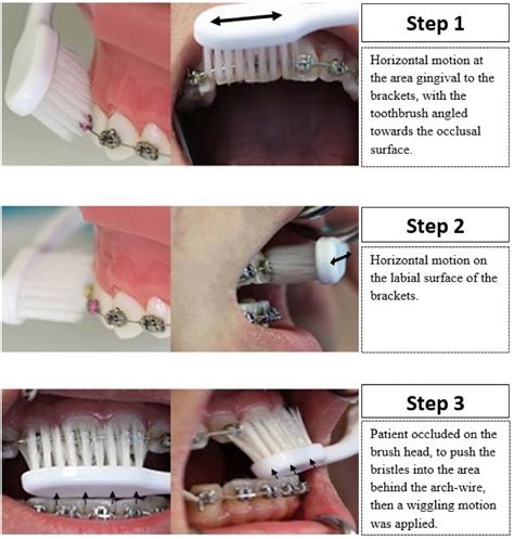 Brushing Technique