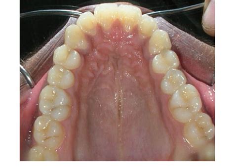 Preoperative Picture Showing Constricted Maxillary Arch Download