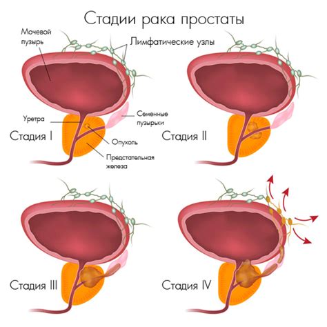 Рак предстательной железы 4 степени: симптомы болезни, способы лечения ...