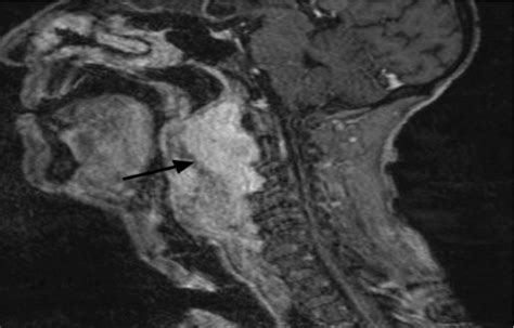 T2 Weighted Mri Neck Showing A Large Hyperintense Lesion Arrow Download Scientific Diagram