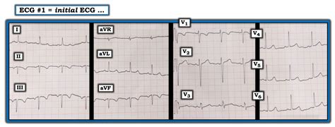 Pulmonary Embolism Ecg