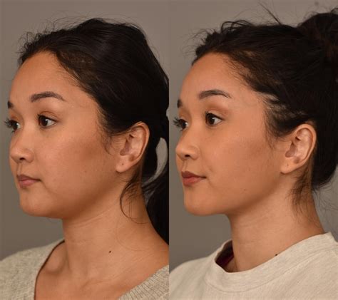 Facial Contouring Buccal Fat Removal Neck Chin Liposuction Cheek