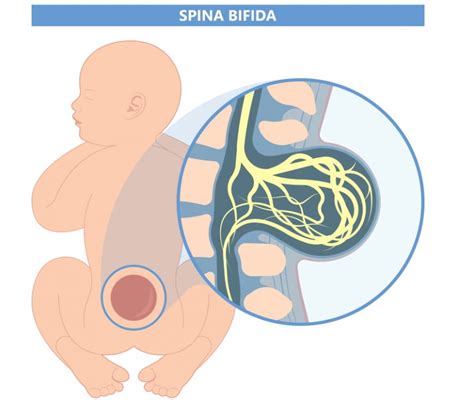 Spina Bifida Diagnosi Prevenzione Cura