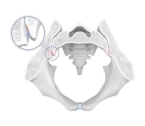 ISG Arthrose Ursachen Symptome Und Therapie