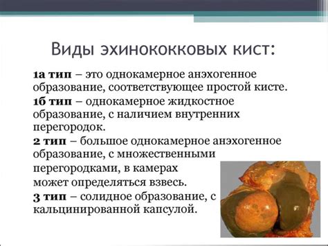 Киста эхинококка: виды, диагностика и лечение