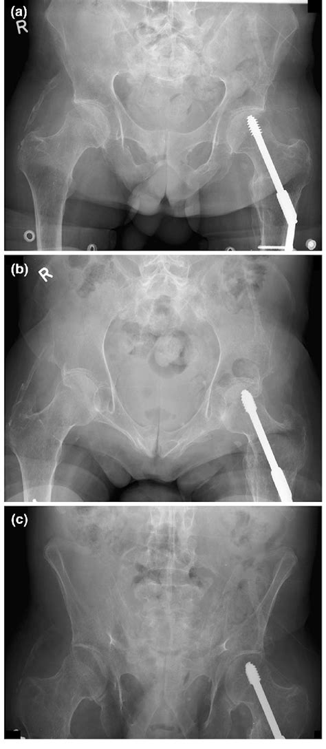 Anteroposterior A Inlet B And Outlet C Radiographs Of The