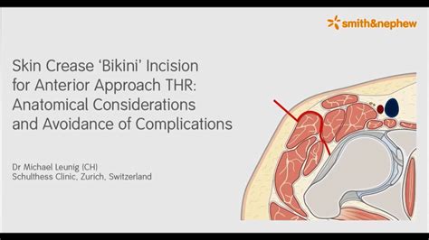 Bikini Incision For Direct Anterior Approach Total Hip Arthroplasty