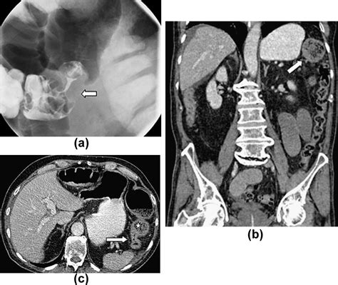 Imaging Manifestations Of Faecal Impaction And Stercoral Perforation Clinical Radiology