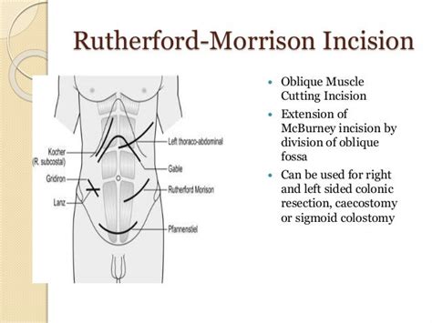 Abdominal Incisions