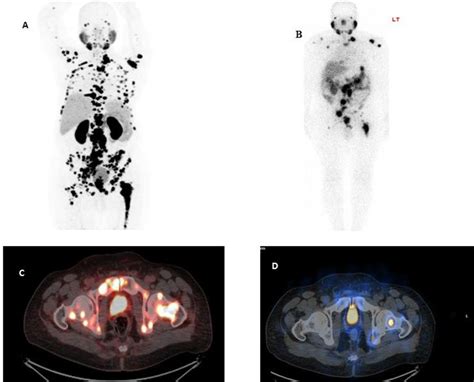 PDF Direct Comparison Of 99mTc PSMA SPECT CT And 68Ga PSMA PET CT In