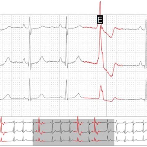 A 12 Lead ECG Showing Ventricular Premature Contractions With Right