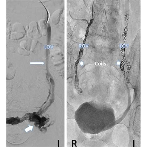 Left Ovarian Venogram Demonstrating Left Ovarian Vein Lov Dilatation