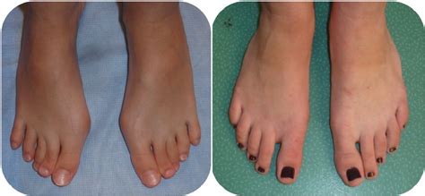 Hallux Valgus Deformidades Dedos Del Pie Extremidad Inferior Infantil