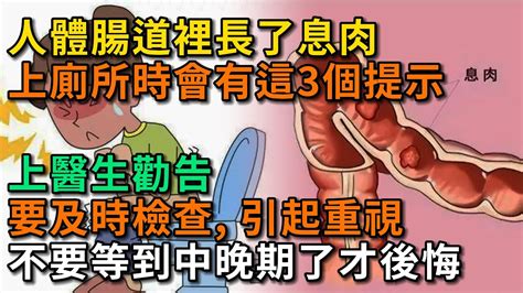 腸道裡長了息肉，上廁所時會有3個提示，醫生勸告：及時檢查，引起重視。不要等到中晚期了才後悔。【幸福talks】中醫養生 中老年心語