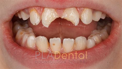 Restauraciones Dentales Con Composite Pla Dental