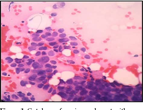 Table From Comparative Evaluation Of Robinsons Cytological Grading