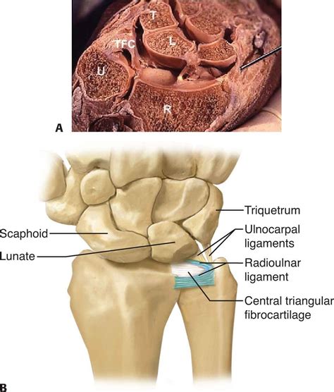 The Armdoc Arthroscopic And Open Triangular Fibrocartilage Complex Repair