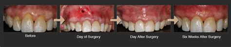 Pinhole® Surgical Technique Alhambra Dental