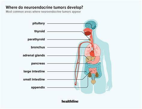 Carcinoid Tumor On Skin