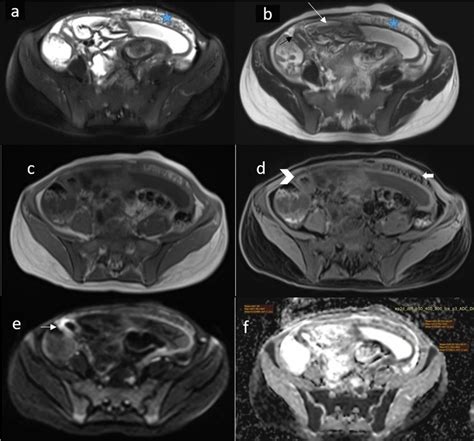 Af T2 Axial Images With And Without FS A B Reveal Omental