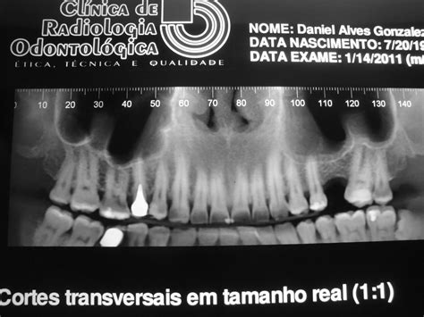 Levantamento Atraumático do Seio Maxilar CIRURGIA BUCOMAXILOFACIAL