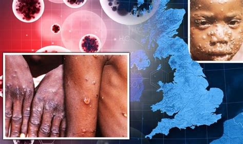 Monkeypox Case Of Rare Virus Confirmed In UK Signs And Symptoms