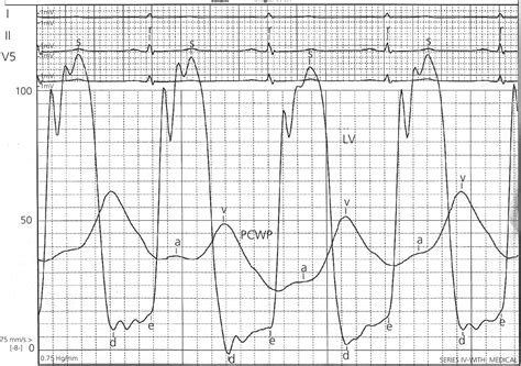 5: The atrial waveform | Thoracic Key