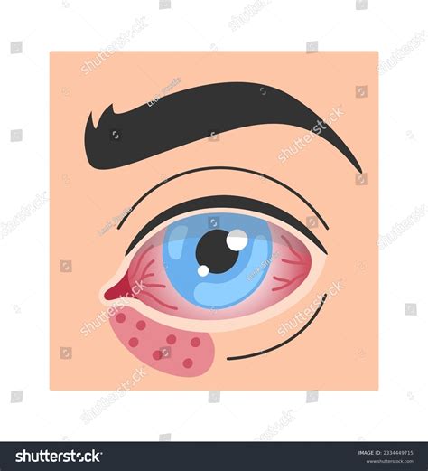 Herpes Simplex Infection Eye Disease Vector Royalty Free Stock Vector