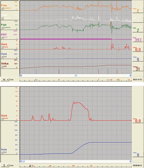 Complete Urodynamic Evaluation Sustained Bladder Contraction During