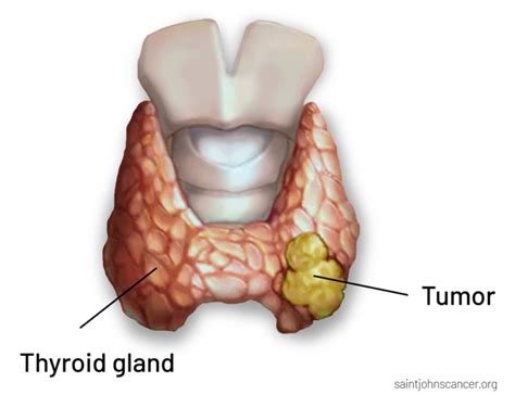 Thyroid Cancer Symptoms Diagnosis Surgery Treatment And Prognosis Saint Johns Cancer