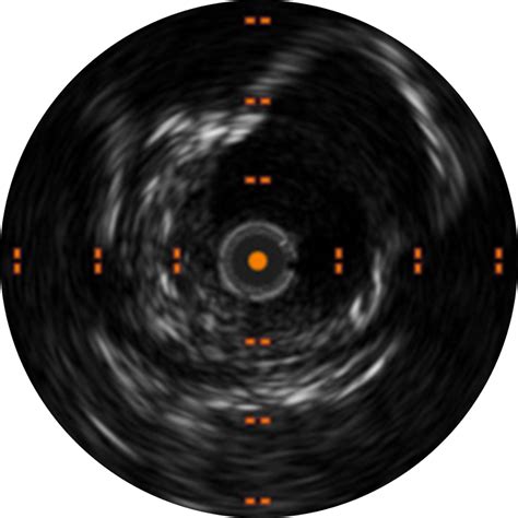 Clarispro™ HD-IVUS extended bandwidth catheter| Infraredx™ | Infraredx