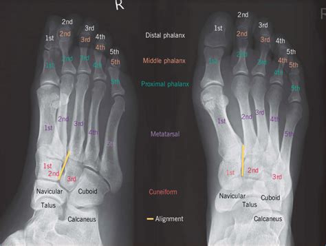 Oblique And Anterior Posterior View X Rays Of A Normal Foot Showing