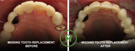 Affordable Tooth Replacement Denver