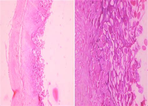 Section Showing Acanthotic Stratifi Ed Squamous Epithelium With Many